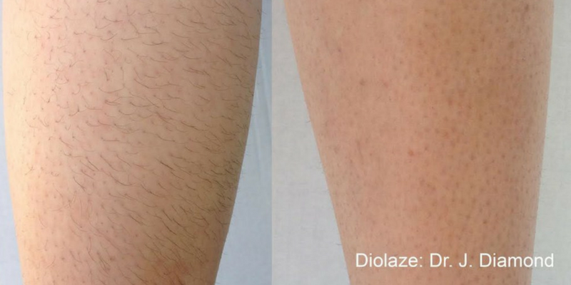 Laser Hair Removal Tattoo Removal Melasmn Hyperpigmentation Sun Damage Spider Veins Eleven Wellness Iv