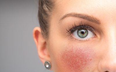 All About Rosacea