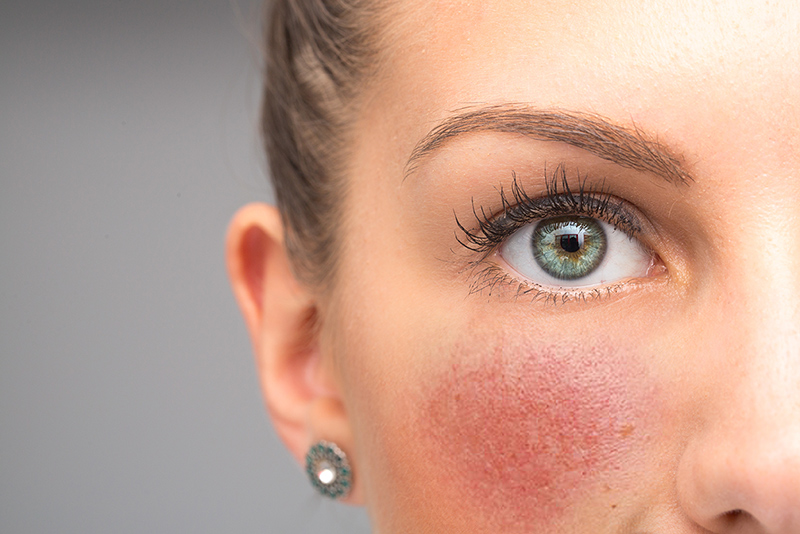 All About Rosacea