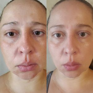 Before and After of our Microcurrent Facial