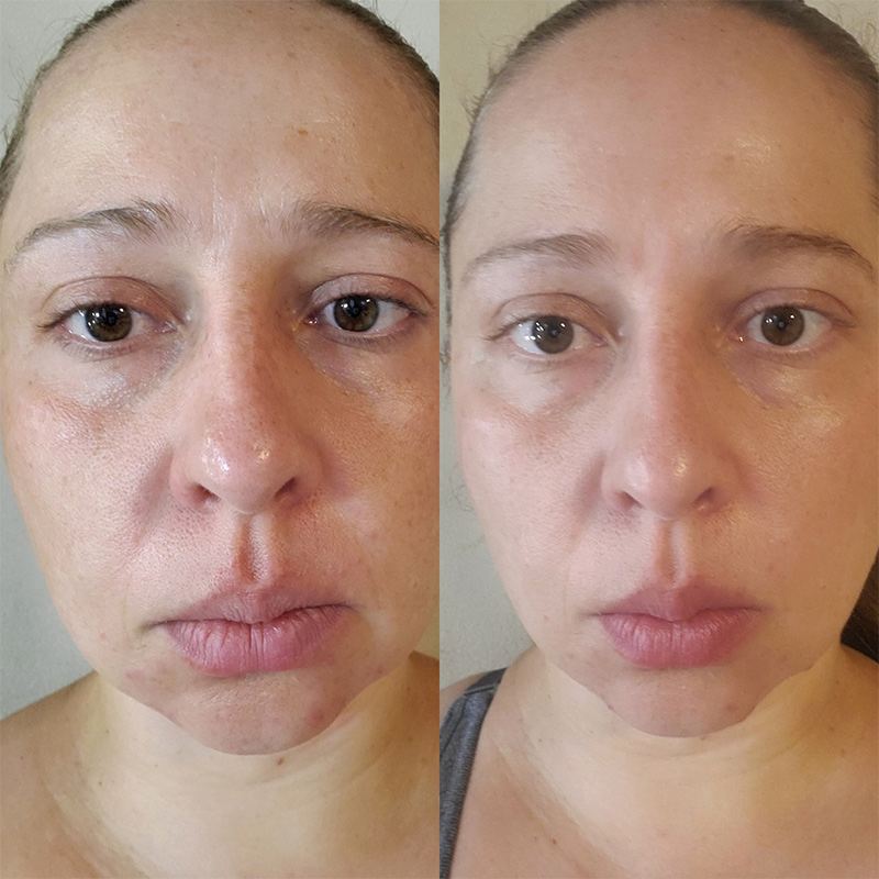 Before and After of our Microcurrent Facial