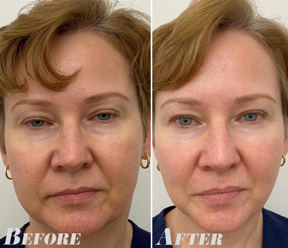 Ultherapy before and after