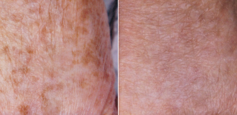 IPL PhotoFacial before and after pics