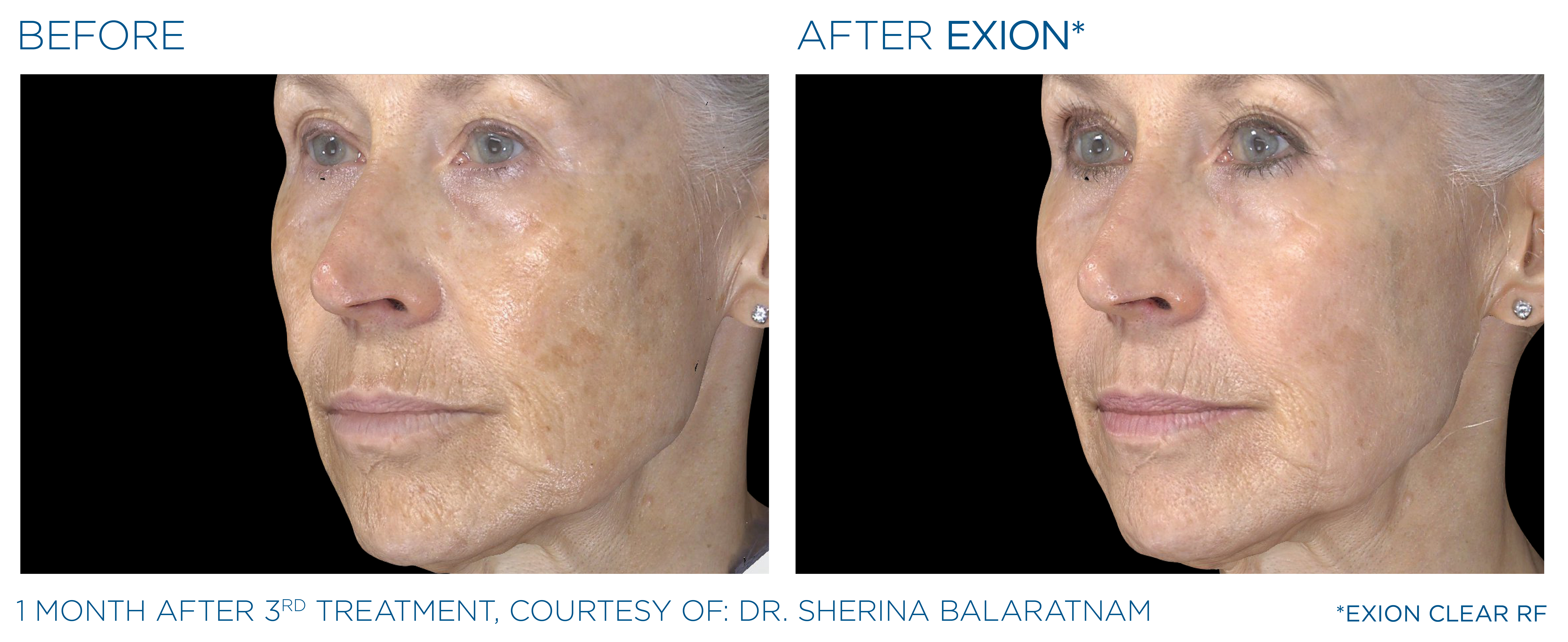 Exion_PIC_Ba-card-cheek-female-100_Clear-RF_ENUS100 1
